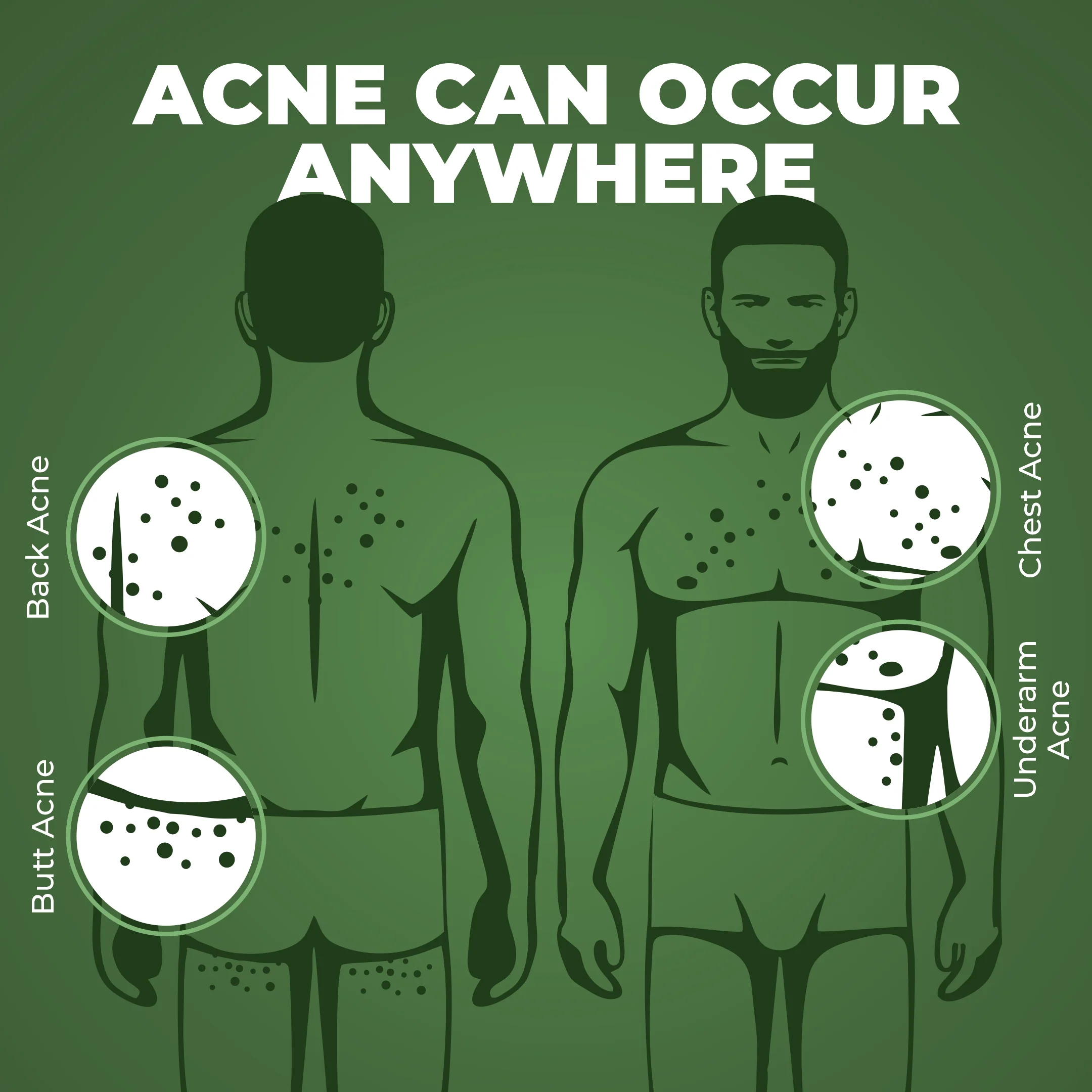 ACNE COMBAT TRIO - Image 10